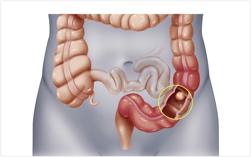 Những dấu hiệu nhận biết ung thư đại tràng 1