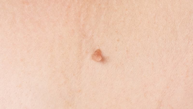 Dấu hiệu nhận biết và điều trị kịp thời sùi mào gà ở nam 1