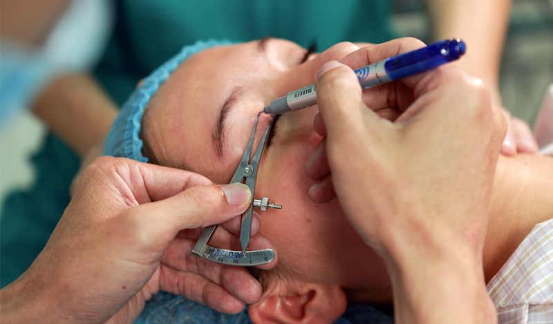 Dấu hiệu nhấn mí bị lộ chỉ? Cách khắc phục hiệu quả và nhanh chóng 2