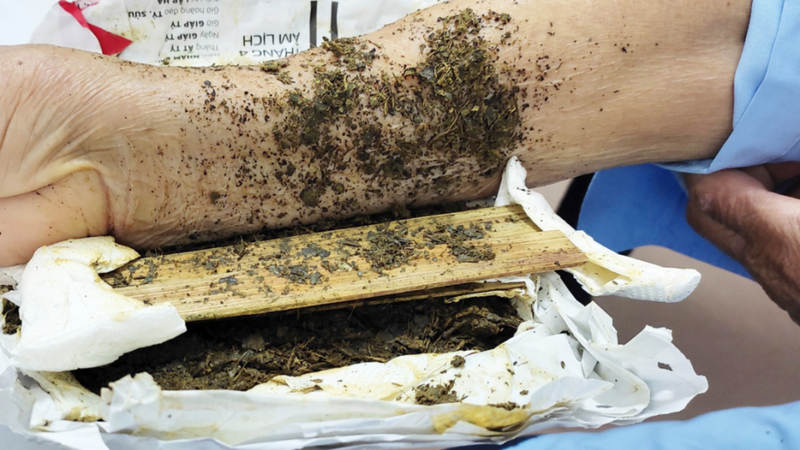 Dấu hiệu nhiễm độc và cách sơ cứu tạm thời khi bị rắn hổ mang cắn 3