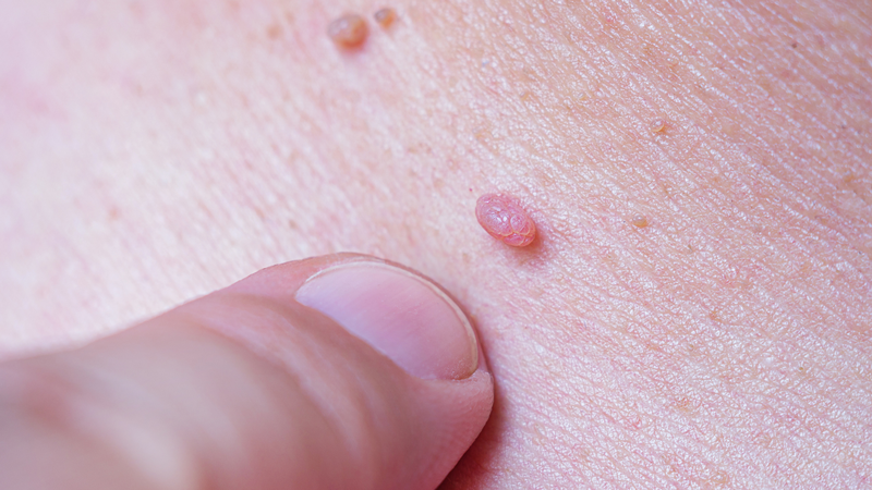 Biểu hiện lâm sàng dễ nhận thấy nhất của HPV là mụn cóc sinh dục