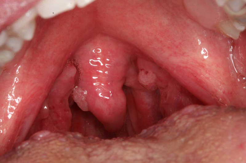 Dấu hiệu nhiễm HPV ở phụ nữ cần nhận biết sớm 3