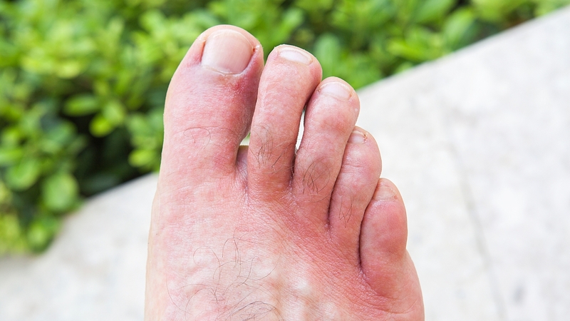 Vùng da tại nơi xâm nhập thường bị nổi mẩn, đỏ, kèm theo cảm giác ngứa râm ran hoặc đau nhẹ