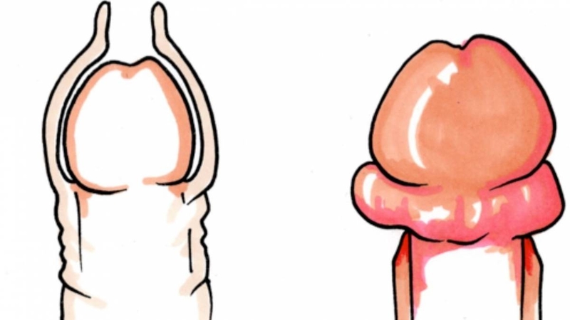 dấu hiệu nhiễm trùng sau khi cắt bao quy đầu