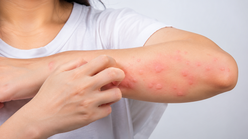 Dấu hiệu nổi mề đay thường gặp là các nốt sẩn phù, ửng đỏ trên da