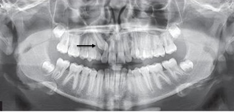 Dấu hiệu răng mọc ngầm