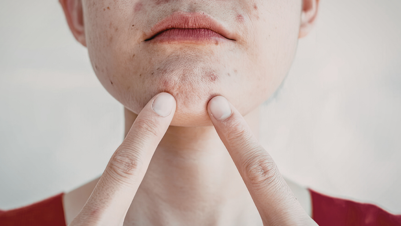 Mụn nội tiết xuất hiện ở vùng cằm hoặc quanh miệng