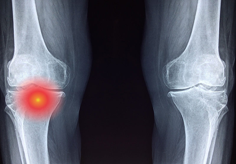 Dấu hiệu Sarcoma xương (U xương ác tính) ở trẻ em và thanh thiếu niên 1