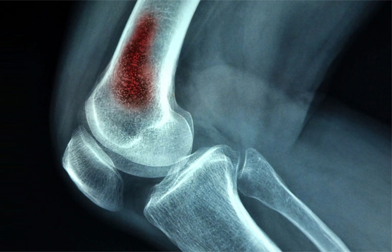 Dấu hiệu Sarcoma xương (U xương ác tính) ở trẻ em và thanh thiếu niên 3
