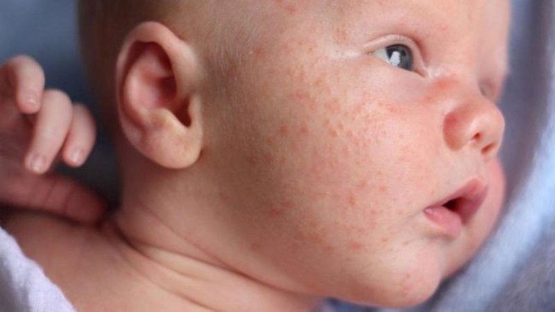 Dấu hiệu sốt phát ban ở trẻ em mà phụ huynh cần biết 1