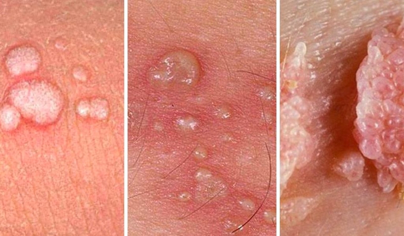 Dấu hiệu sùi mào gà ở nam giới giai đoạn đầu? Bệnh có tự hết không? 1