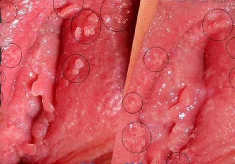 Dấu hiệu sùi mào gà ở nữ giai đoạn đầu có nguy hiểm không? 1