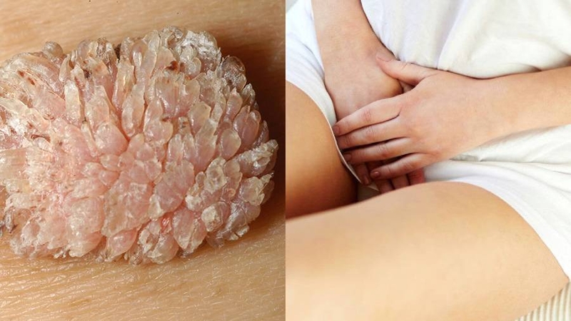 Dấu hiệu sùi mào gà ở nữ? Khi nào cần đi khám phụ khoa ngay? 4