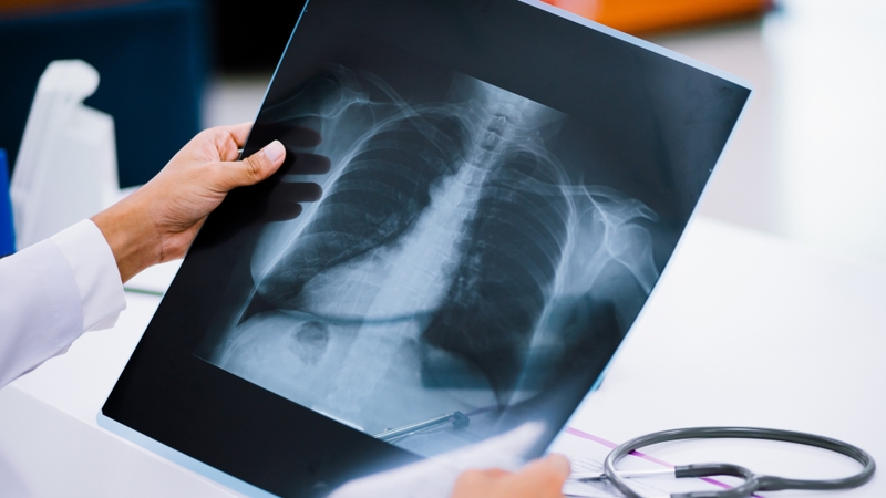 Dấu hiệu suy hô hấp sơ sinh là gì? Nguyên nhân, phương pháp chẩn đoán và xử trí 3