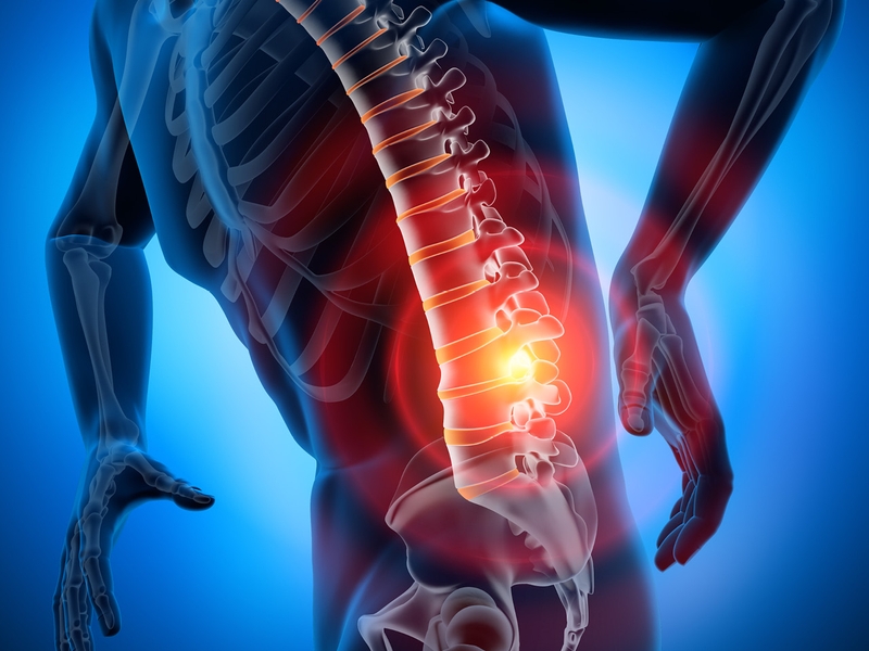 Dấu hiệu thoát vị đĩa đệm mông và các biến chứng nguy hiểm 1