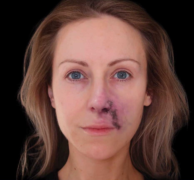 Dấu hiệu tiêm filler mũi bị hoại tử là gì?1