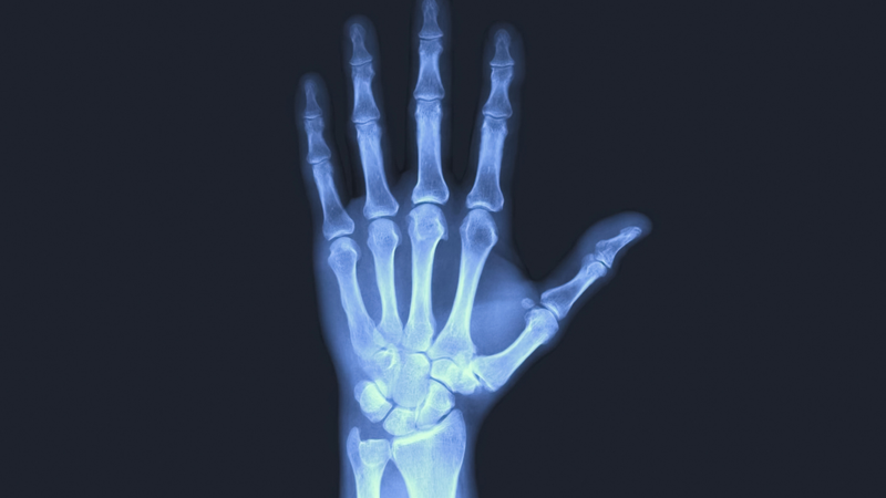 NCS, EMG và chẩn đoán hình ảnh giúp đánh giá thêm tổn thương thần kinh