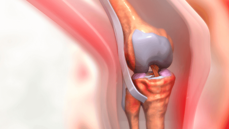 Dấu hiệu tràn dịch khớp gối và hướng điều trị 1