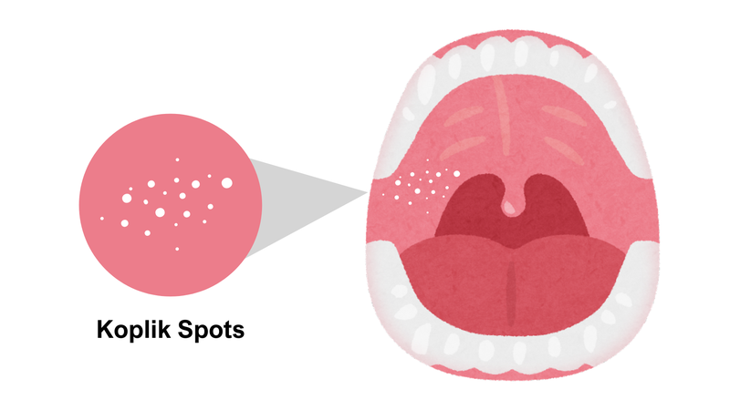 Dấu hiệu trẻ bị sởi phụ huynh cần biết để xử trí kịp thời 2