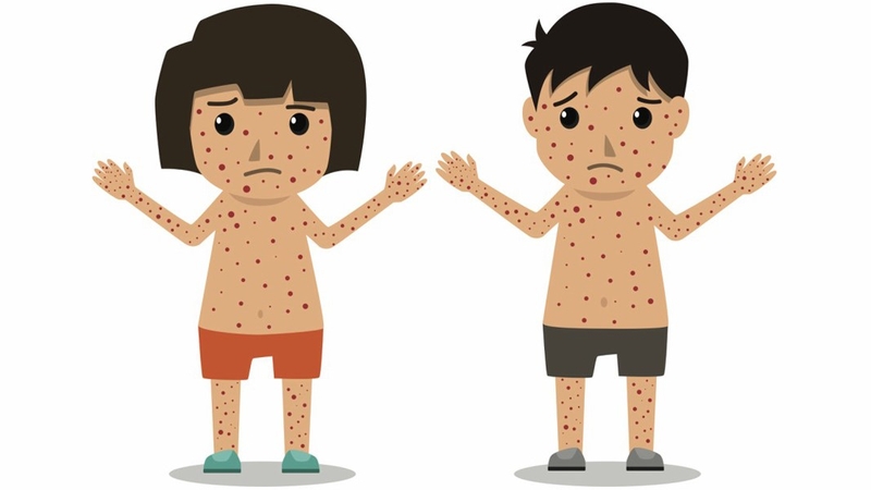 Dấu hiệu trẻ bị sởi phụ huynh cần biết để xử trí kịp thời 1