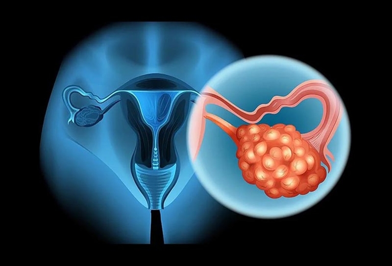 Dấu hiệu u nang buồng trứng và các phương pháp điều trị u nang buồng trứng 1