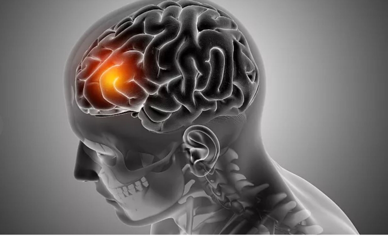 Dấu hiệu ung thư não mà bạn nên biết 2