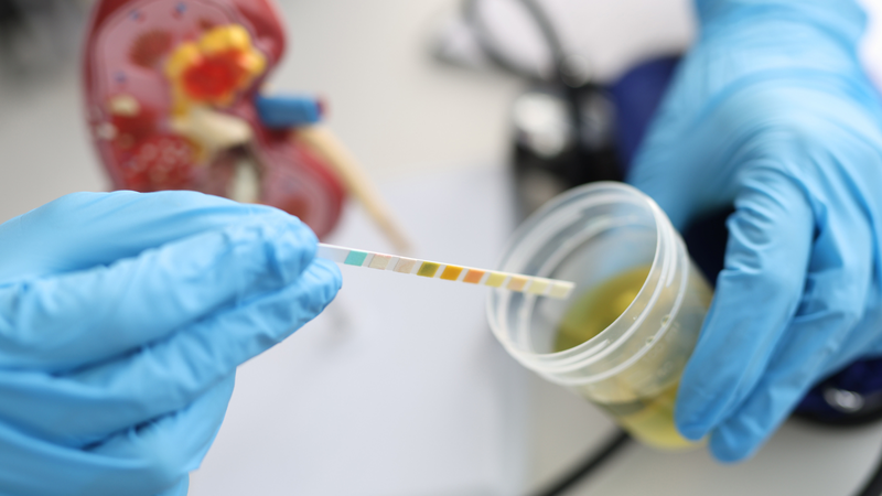 Xét nghiệm nước tiểu là xét nghiệm cơ bản nhưng quan trọng