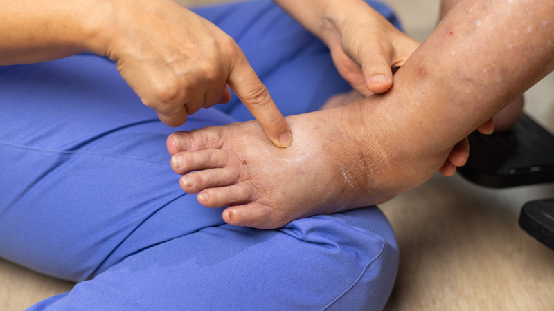 Biến chứng huyết khối tĩnh mạch sâu có thể gây phù chân