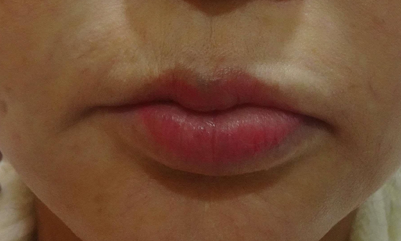 Dấu hiệu khi tiêm filler môi bị vón cục