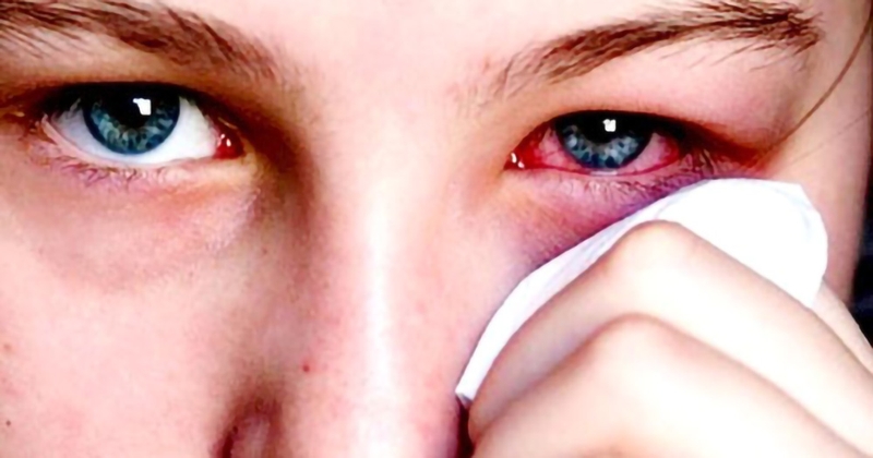 Viêm kết mạc họng hạch thường thấy ở vùng khí hậu nóng ẩm, được xác định là một bệnh cấp tính do virus gây ra