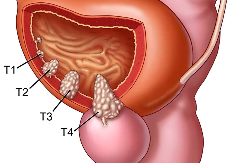 Dấu hiệu và phương pháp điều trị bệnh ung thư bàng quang giai đoạn cuối 1