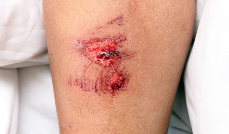 Dấu hiệu vết thương bị hoại tử điều trị như thế nào để không phải cắt bỏ 1