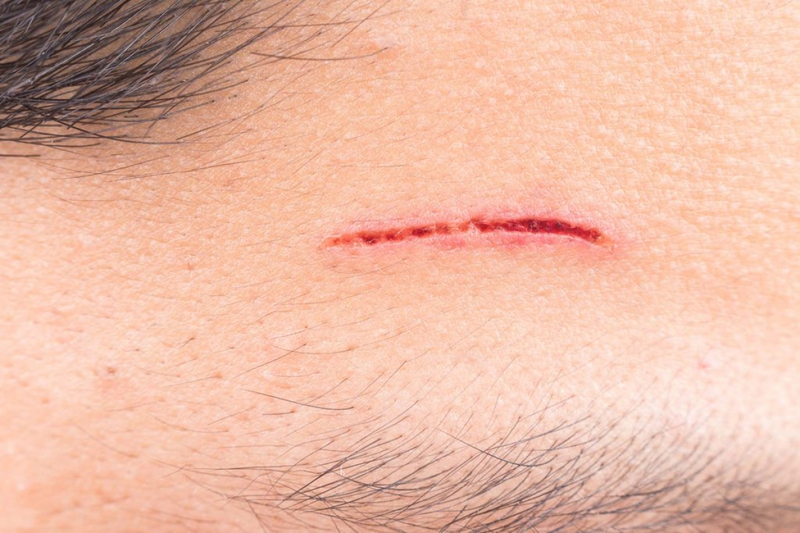 Dấu hiệu nhiễm trùng của vết thương 1