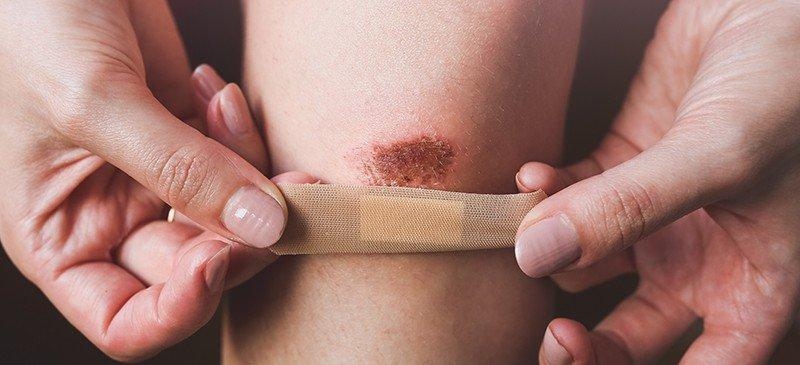 Những dấu hiệu vết thương đang lành rõ ràng nhất 2