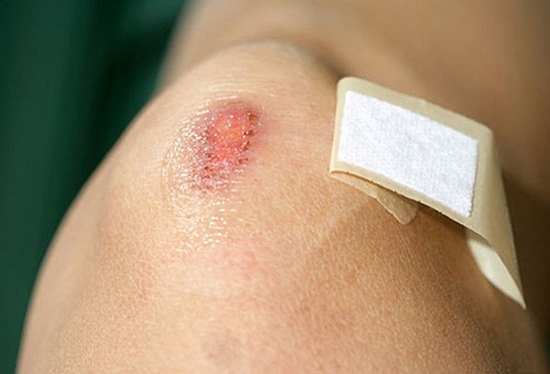 Những dấu hiệu vết thương đang lành rõ ràng nhất 3