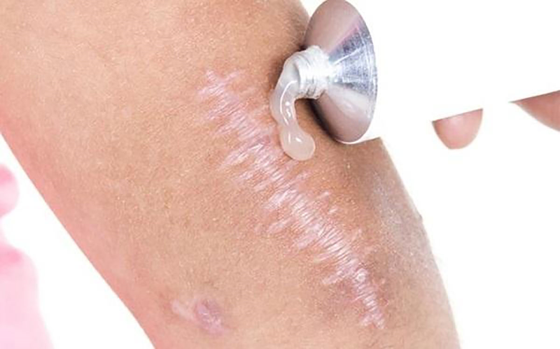 Những dấu hiệu vết thương đang lành rõ ràng nhất 4