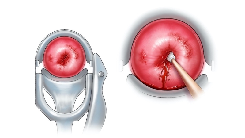 Dấu hiệu viêm cổ tử cung là gì? Nguyên nhân, điều trị và cách phòng tránh viêm cổ tử cung 1