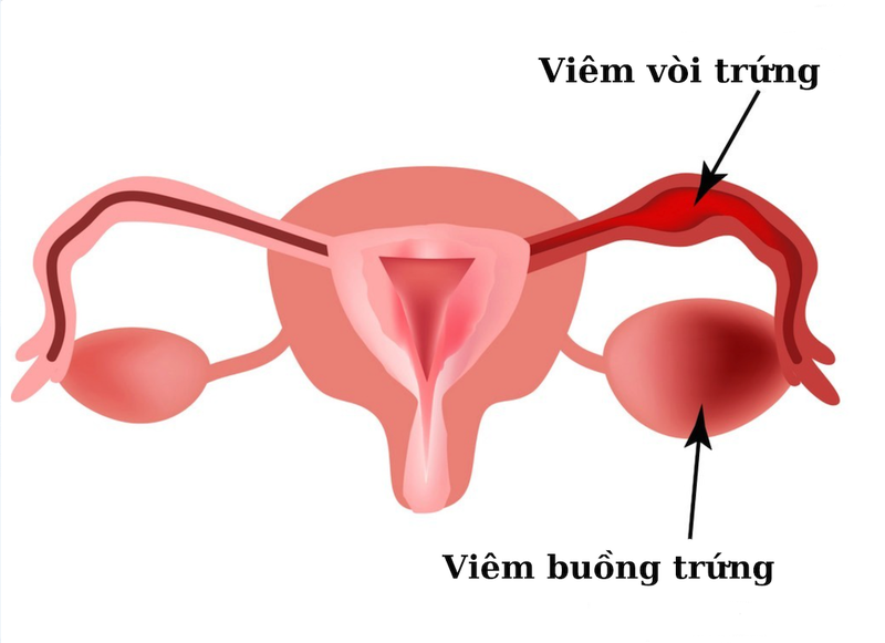 Dấu hiệu viêm cổ tử cung là gì? Nguyên nhân, điều trị và cách phòng tránh viêm cổ tử cung 3