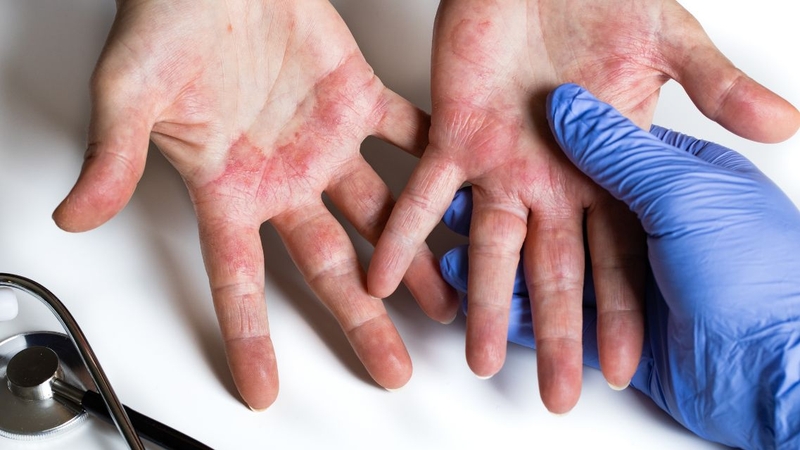 Dấu hiệu viêm da cơ địa thay đổi tùy độ tuổi và giai đoạn bệnh