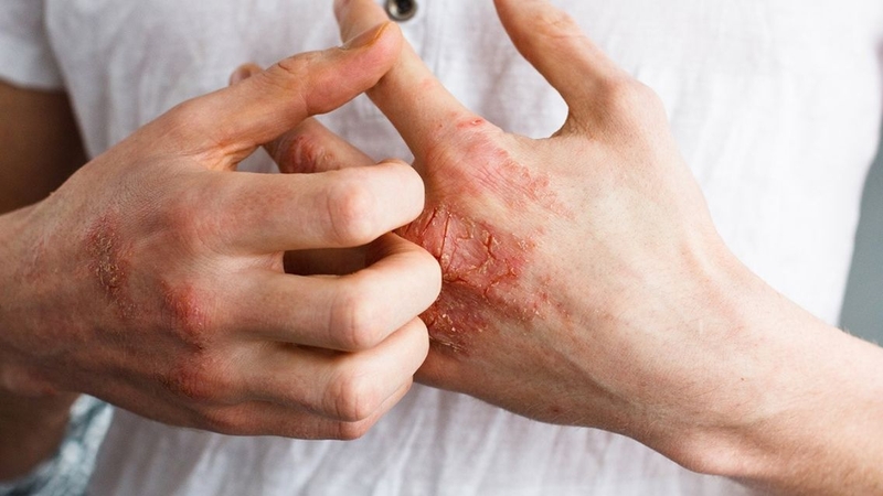 Tổn thương da có thể đỏ, bong tróc hoặc nứt nẻ
