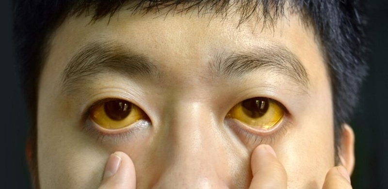 Dấu hiệu viêm gan D và hướng điều trị không phải ai cũng biết 2