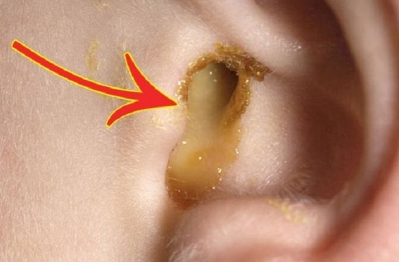 Dấu hiệu viêm tai giữa người lớn là gì? 1