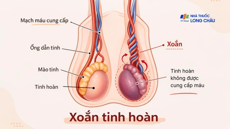 Xoắn tinh hoàn xảy ra khi tinh hoàn xoắn quanh thừng tinh, làm tắc nghẽn mạch máu