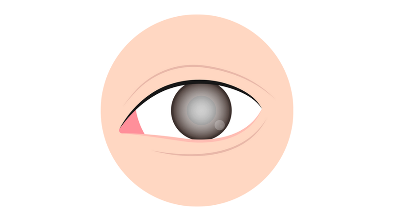 dau-hong-mat-do-ghen-nguyen-nhan-va-cach-dieu-tri 2