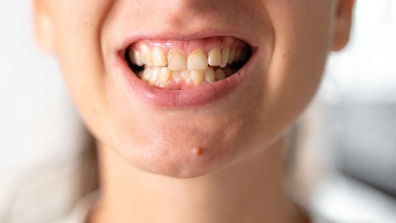 Sâu răng ở vị trí tiếp xúc giữa hai răng thường khó phát hiện