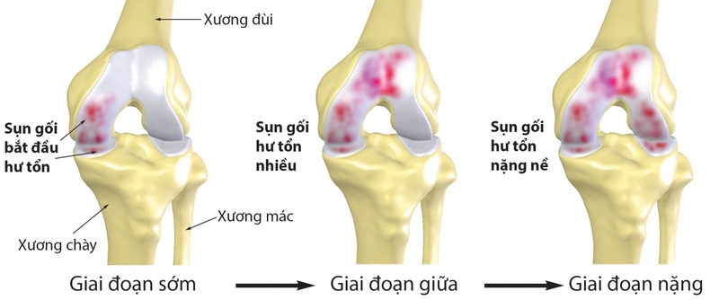 Đau khớp gối dấu hiệu bệnh gì? 1