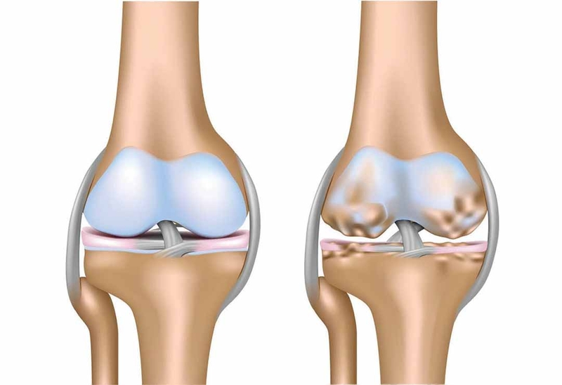 Đau khớp gối tập thể dục như thế nào? Các bài tập hiệu quả dành cho người đau khớp gối 1