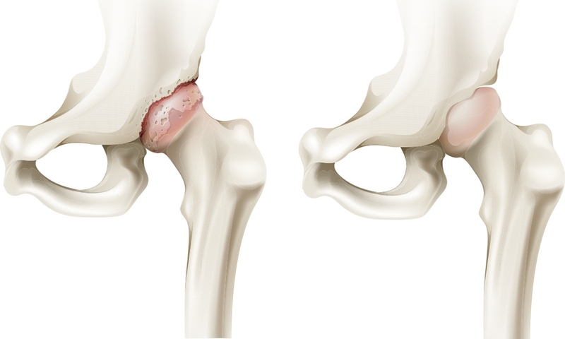 Đau khớp háng: Nguyên nhân và cách điều trị hiệu quả 2