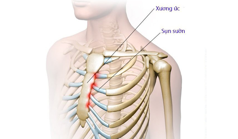 Đau khớp sụn sườn hay còn gọi là viêm khớp sụn sườn