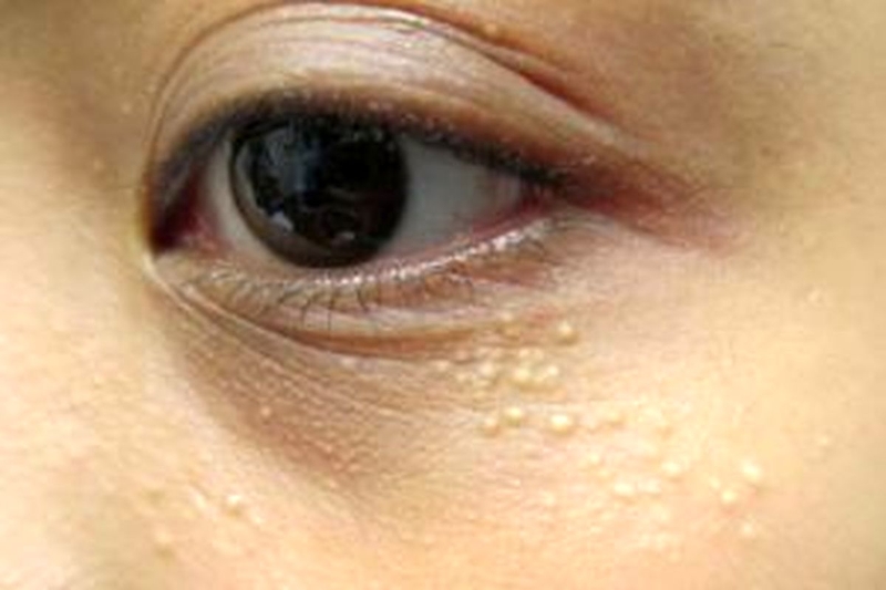 cách trị mụn gạo mí mắt hiệu quả